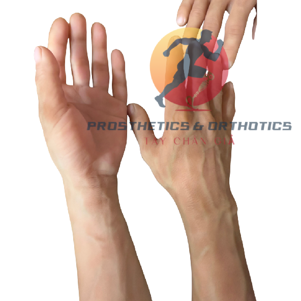 Tay thẩm mỹ làm theo khuôn